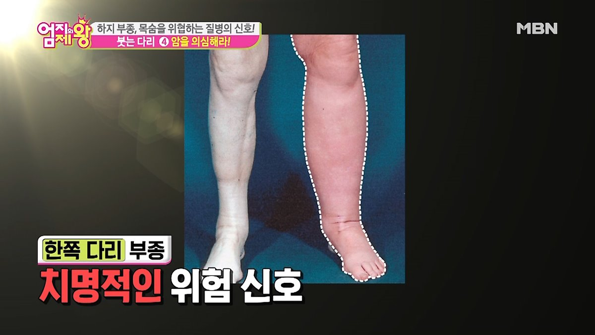  다리 부종에 좋은차 알아보기