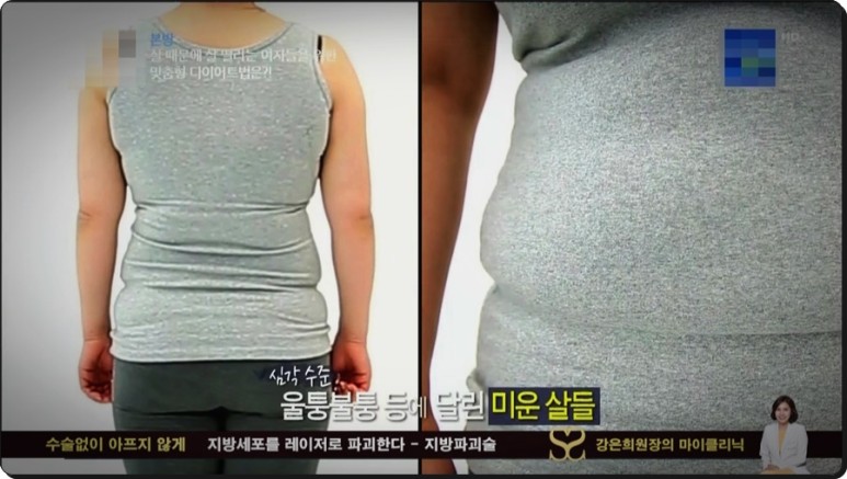 셀룰라이트 제거까지 지방파괴술 효과, 뱃살 다이어트부터 복부 2