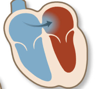  난원공 개존증(Patent Foramen Ovale) : 난원공 개존증 뇌졸중, 난원공 개존증 원인, 난원공 개존증 증상, 치료 방법