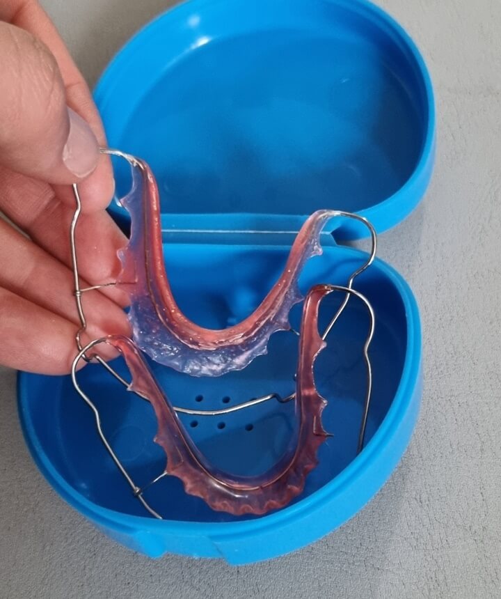 치아교정 유지장치 비용 기간 3년 지난 솔직 후기 평생 해야할까 치아교정 유지장치 비용 기간 3년 지난 솔직 후기 평생 해야할까