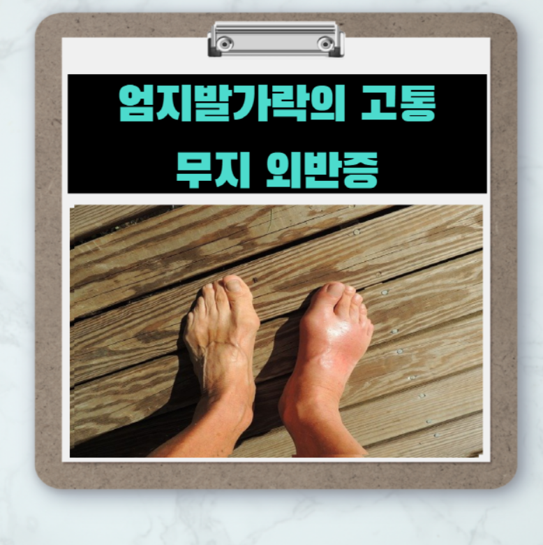  엄지발가락이 휘어지기 시작하는 '무지 외반증'