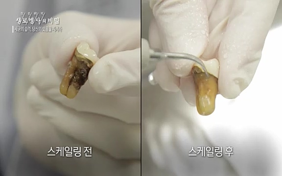 [792회] 생로병사의 비밀 - KBS[세균의 습격, 당신의 잇몸을 지켜라!] 감기보다 병원을 더 자주 찾게 만드는 질병이 있다. 바로 치주질환이다. 2020년 외래 다빈도 질병 1위를 차지한 치은염 및 치주질환 환자는 1,637_20220505_141610.590.jpg