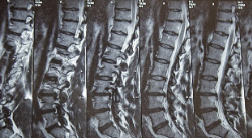 Herniated Disc 다리 마비의 증상