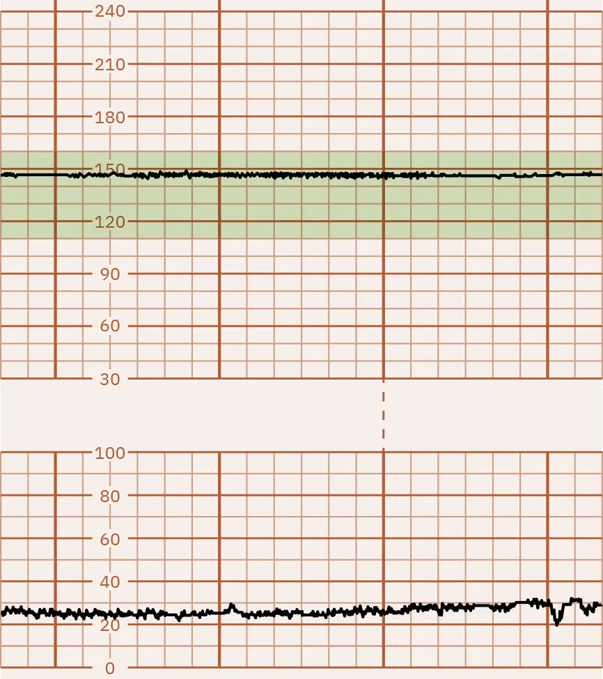Absent FHR variability