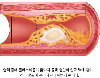  [당뇨!!] 바보야 핵심은 혈당이 아니야~2