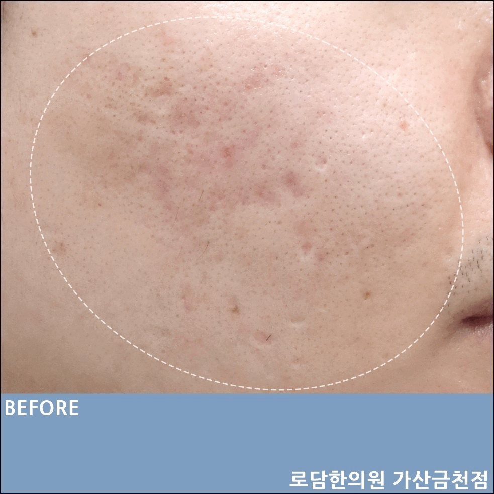  부천 여드름 흉터 제거 새살침 코라테라피 관리 과정