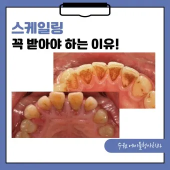 스케일링 후 양치 통증 음식_16