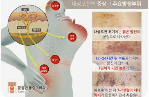 대산포진 증상 사진