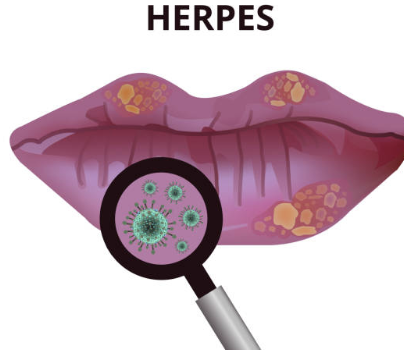 헤르페스 2형 성병