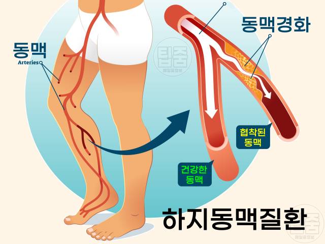 걸을때 종아리가 아파요 하지동맥질환 증상