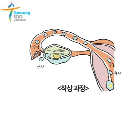 착상과정 착상통(출처:삼성수)