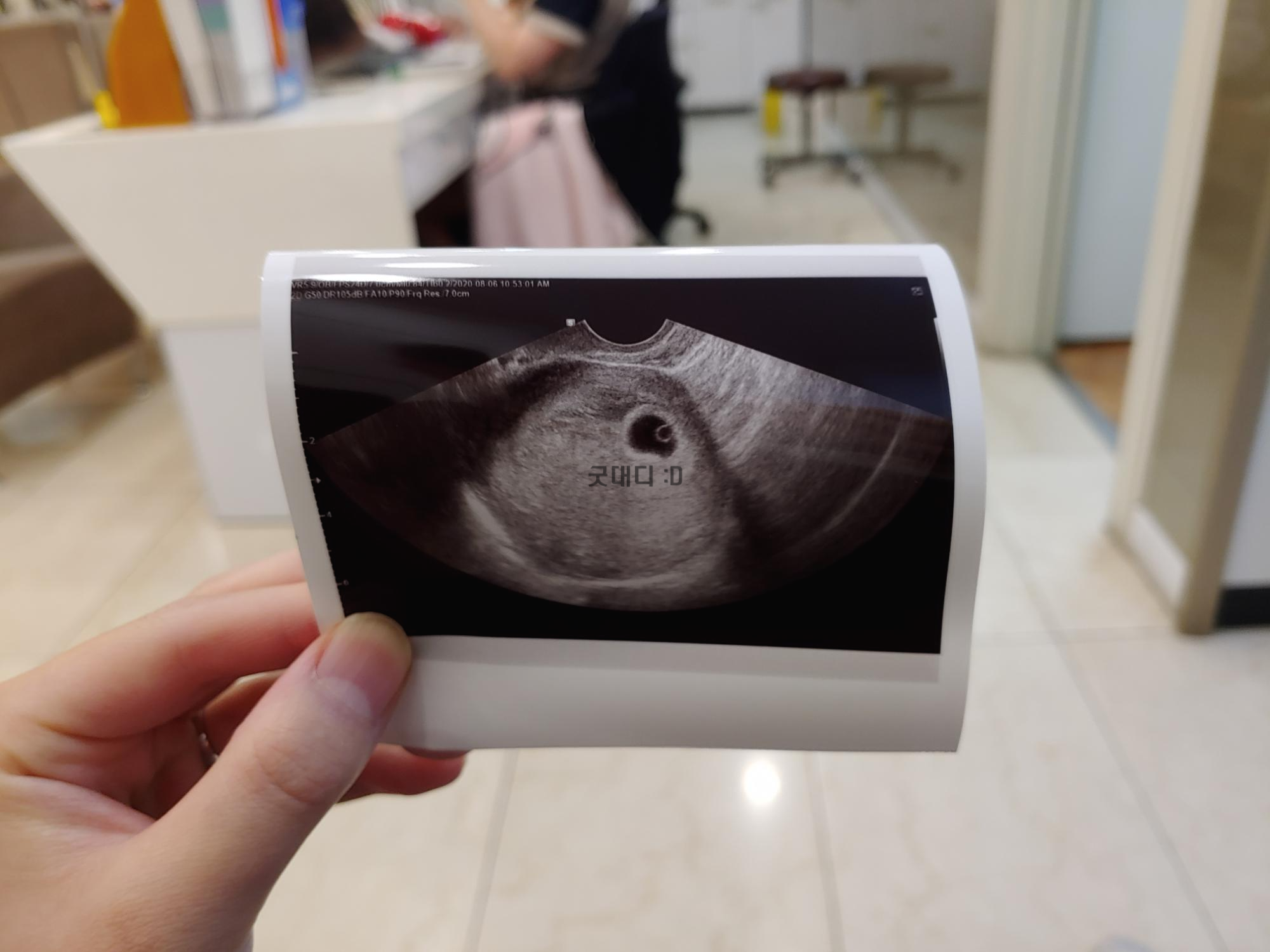  임신 2개월 초기감기증상과 유산징조 및 임신오조
