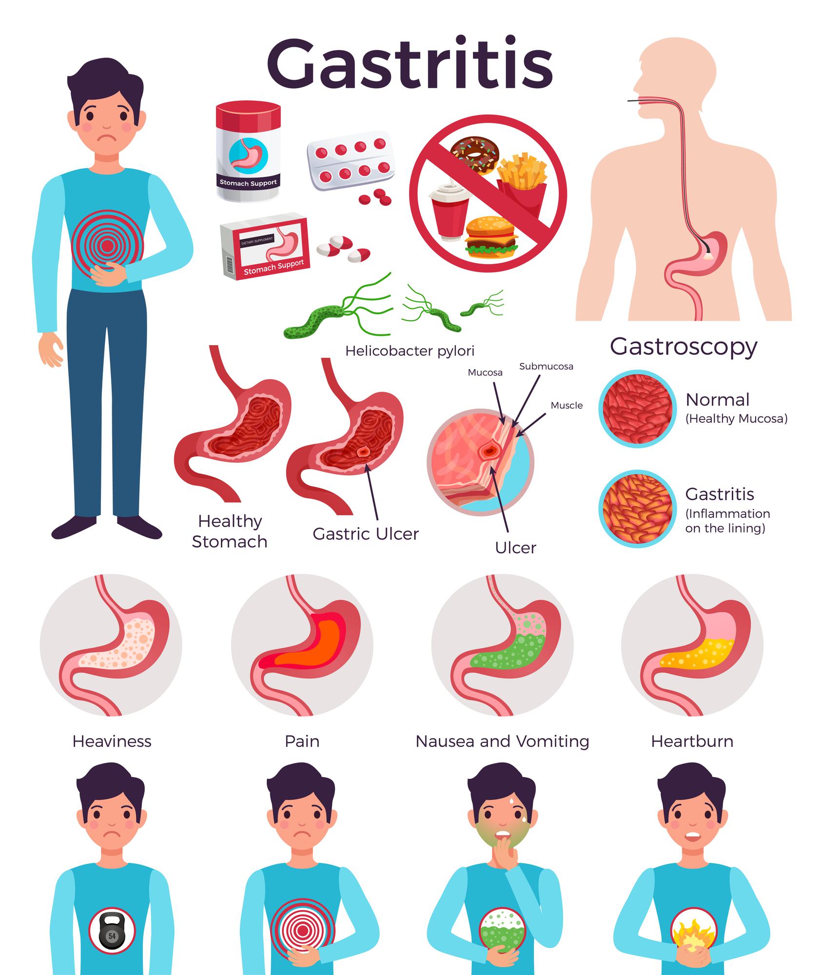  스트레스로 인한 급성 위염(gastritis), 생활습관 점검하기
