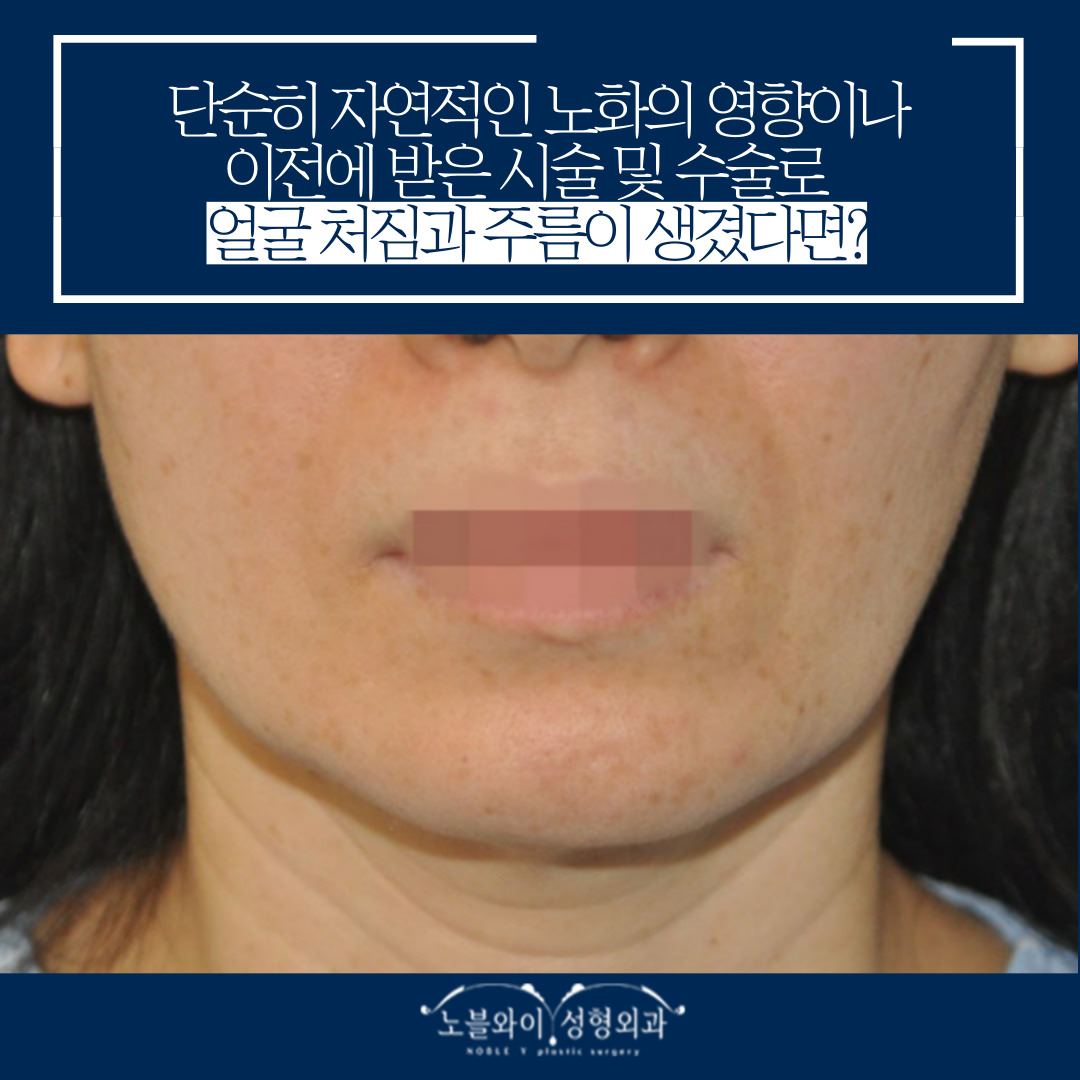 부산 티타늄 리프팅 시술 후 바로 느껴지는 턱선 변화! (내돼지내산 후기) 3