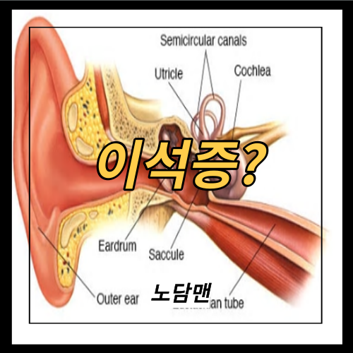 이석증 이란