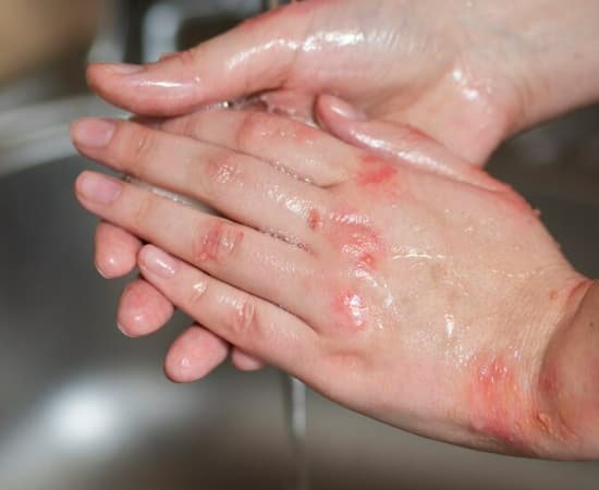 손에-습기가-많으면-세균감염이-쉽게-일어납니다.