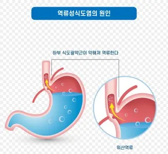 역류성 식도염 원인 초기증상 예방하는 방법_18
