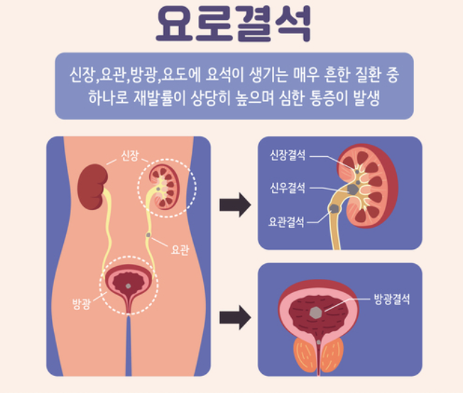 요로결석 증상 2