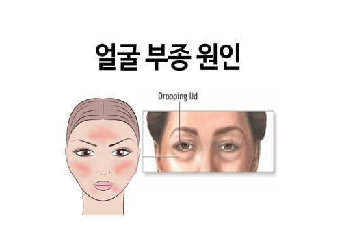 부종원인-얼굴상태-비교