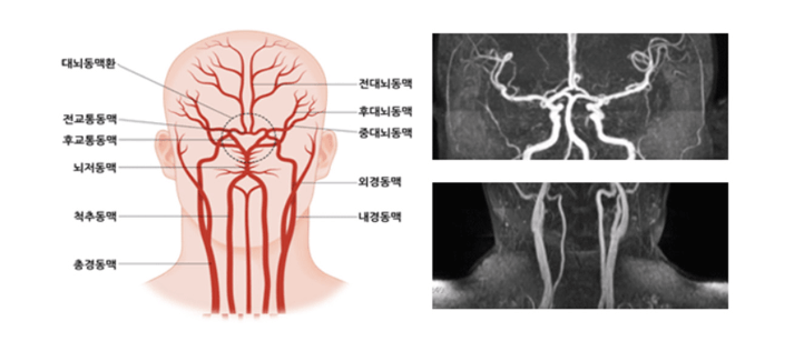 왼쪽은 사람의 머리, 전대뇌동맥, 척추동맥, 내경동맥을 포함한 11개 혈관의 위치와 이름이 적힌 해부도이고, 오른쪽은 뇌경색과 뇌출혈의 영상을 X-ray와 같이 보여준다.