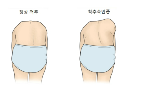 척추측만증 진단법