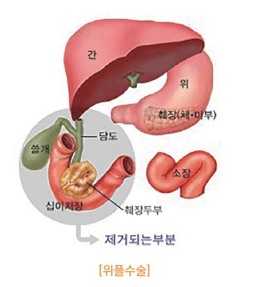  췌장암 초기증상 (원인 및 치료법)