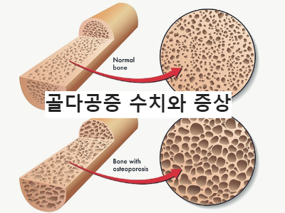 골다공증 수치와 증상&amp;#44; 예방법