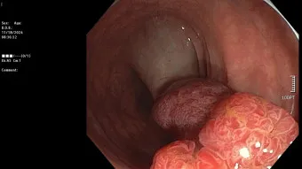 대장내시경 용종제거 후 식사 식단조절_17