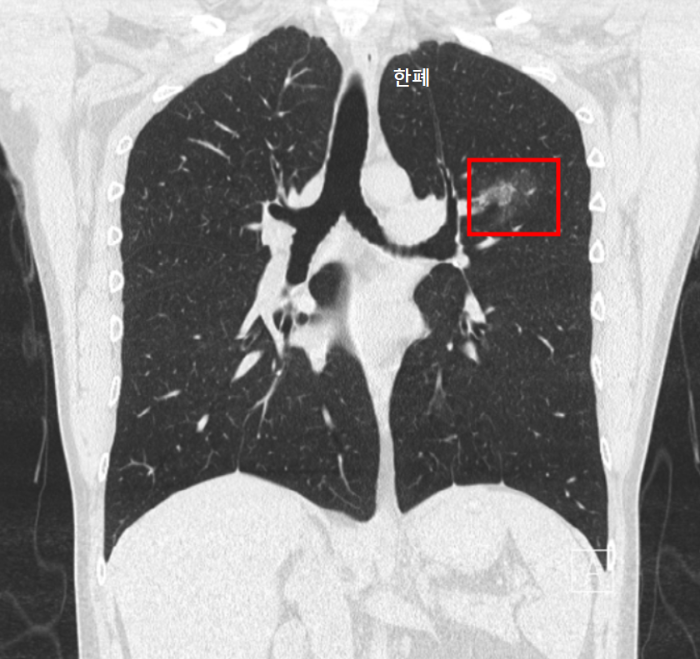 폐결절 CT 사진