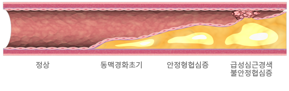 동맥경화의 진행과정 이미지