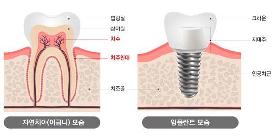  임플란트 심기 전, 치아 최대한 살려야 하는 이유
