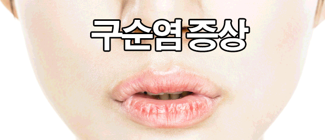  입술 구순염 원인 및 치료 : 헤르페스, 수포
