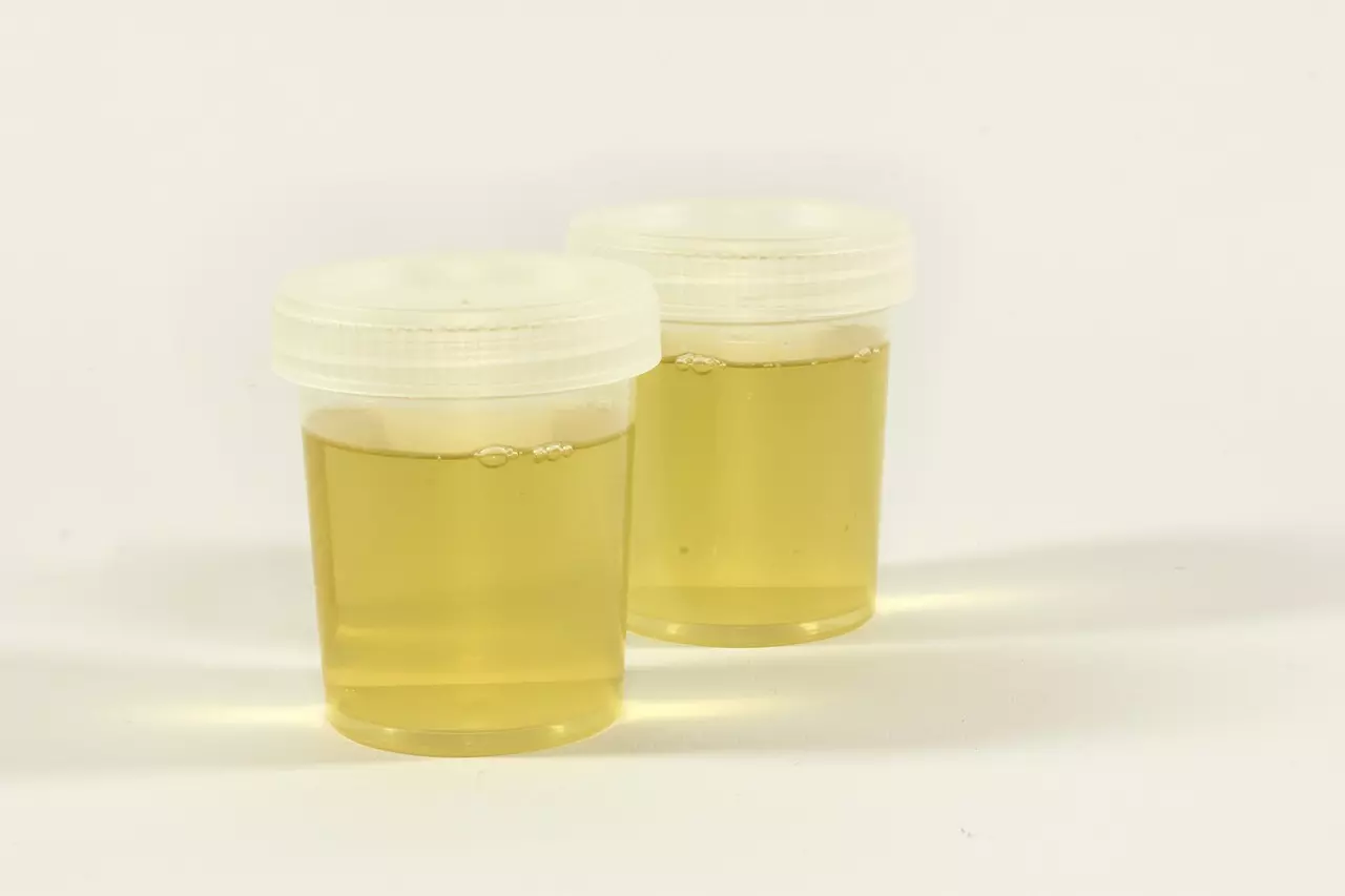 소변색 탁함? 소변이 평소보다 탁하다면 꼭 확인해보세요