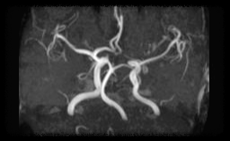 뇌혈관 mri 영상