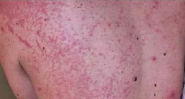  엠폭스(원숭이두창.MPOX)100명 돌파 급만남 주의보!