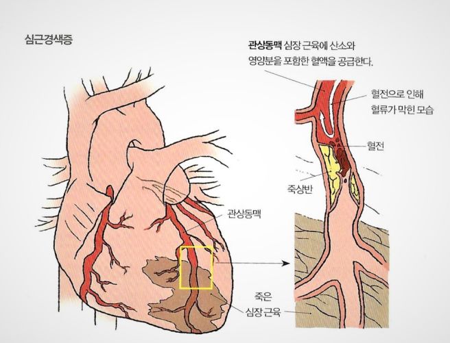 심근경색 전조증상