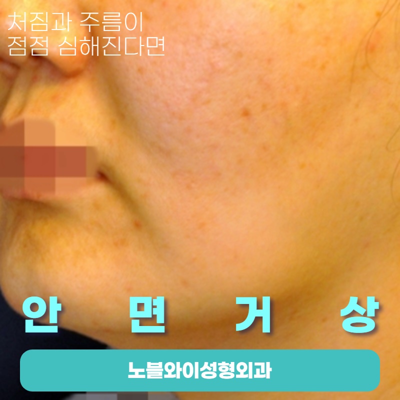  안면거상술잘하는성형외과 흉터도 좋음
