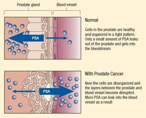 전립선암 psa수치
