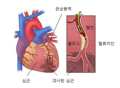 심근경색-정의