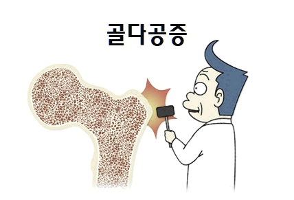  골다공증 초기 증상과 원인 및 예방법 5가지
