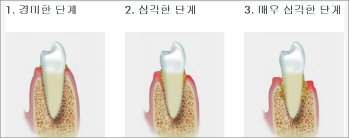 치주염진행단계