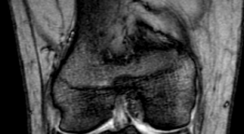 무릎 MRI 촬영 사진