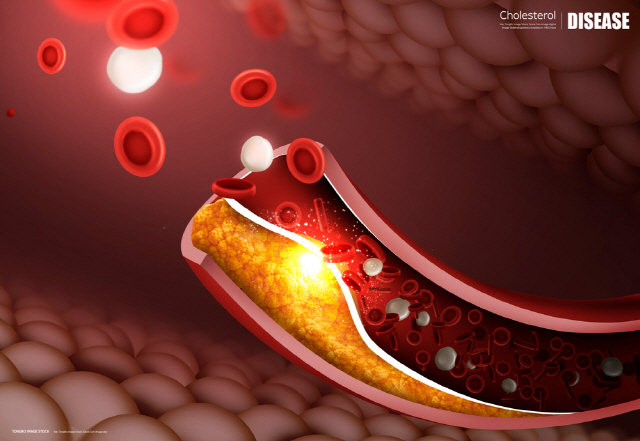 콜레스테롤 수치 올라가는 원인&#44; 수치를 낮추는방법