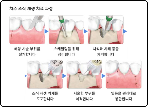 엠도게인 치료법 순서