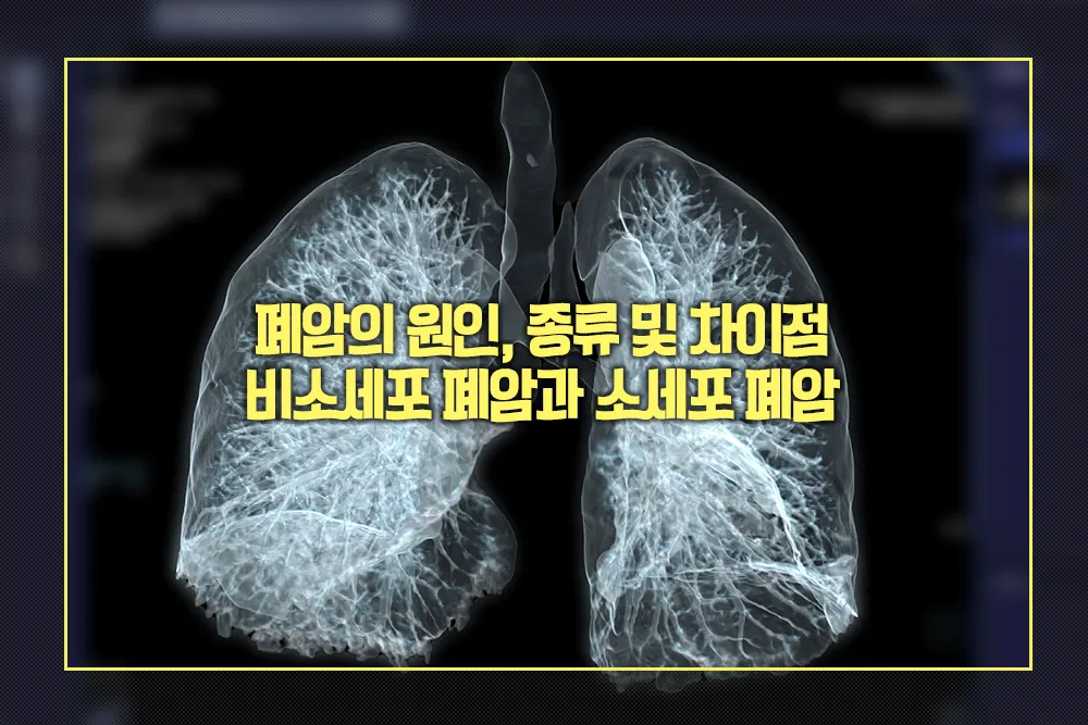 폐암의 원인 종류 유형별 차이점