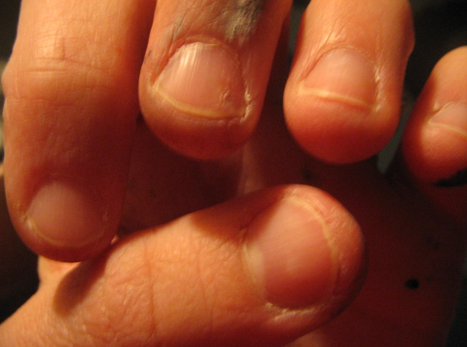 손가락 관절 통증과 부종의 원인은 무엇인가요?