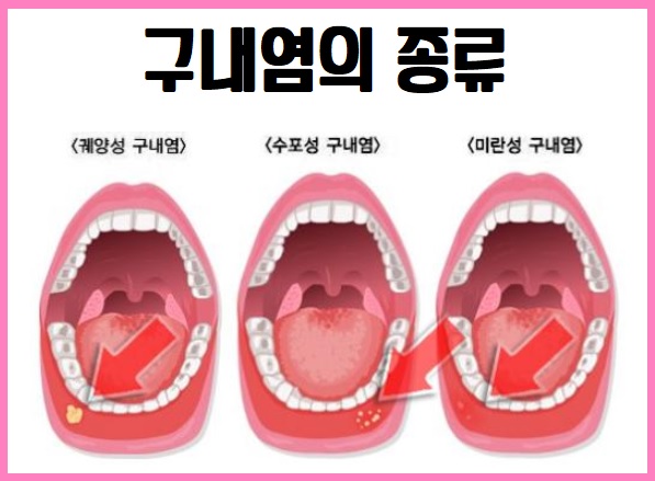 구내염 종류
