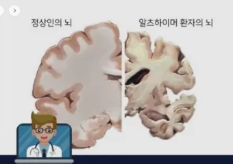 알츠하이머와 치매 차이_5