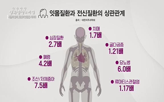 [792회] 생로병사의 비밀 - KBS[세균의 습격, 당신의 잇몸을 지켜라!] 감기보다 병원을 더 자주 찾게 만드는 질병이 있다. 바로 치주질환이다. 2020년 외래 다빈도 질병 1위를 차지한 치은염 및 치주질환 환자는 1,637_20220505_141012.577.jpg