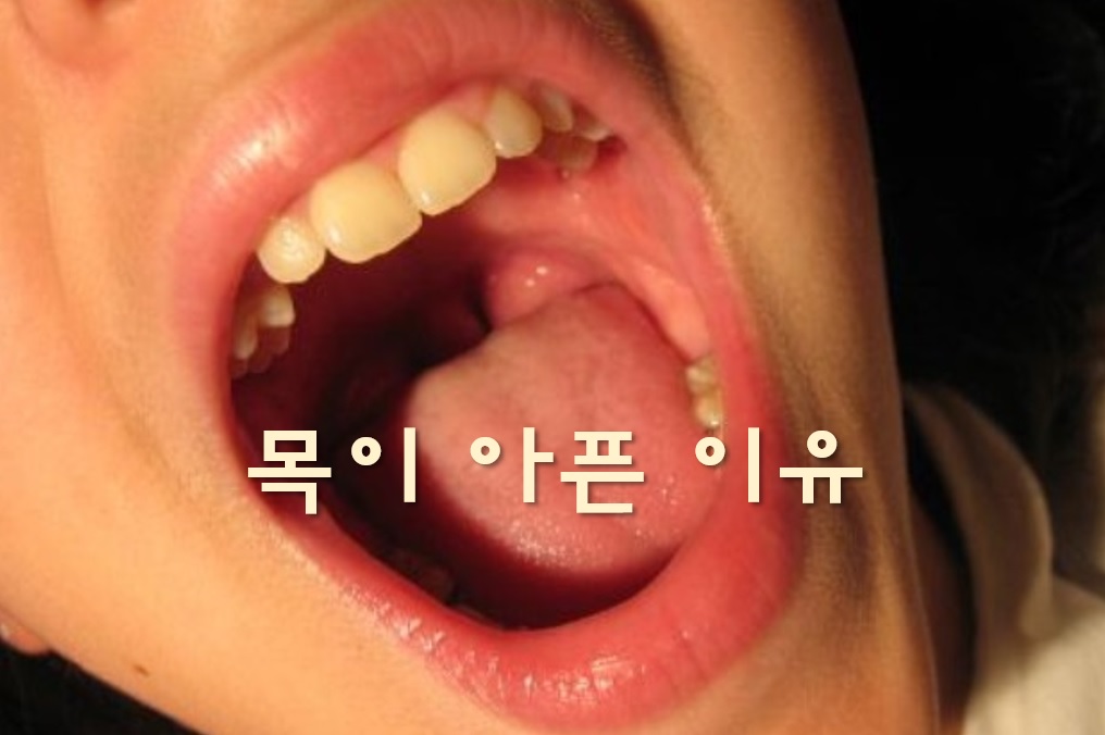  목이 아픈 이유와 목이 붓고 아플 때 치료방법